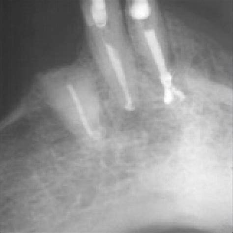 Radiograph taken about 5 years before current treatment, showing ...