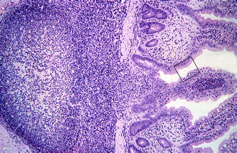 HLS [ Lymphoid Tissues and Organs, ileum, Peyer's patches] MED MAG