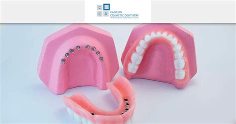 What's the procedure for Snap in Dentures in Cancun Dentistry?