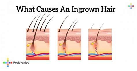 What Causes An Ingrown Hair