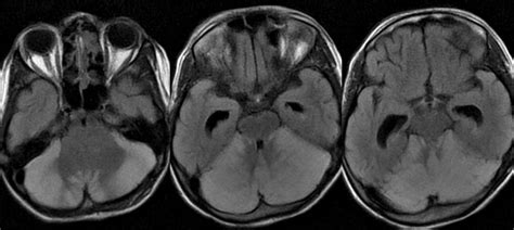 Dr Balaji Anvekar FRCR: Acute cerebellitis MRI