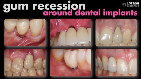 gum recession around dental implants kazemi oral surgery | gum recession around dental implants ...