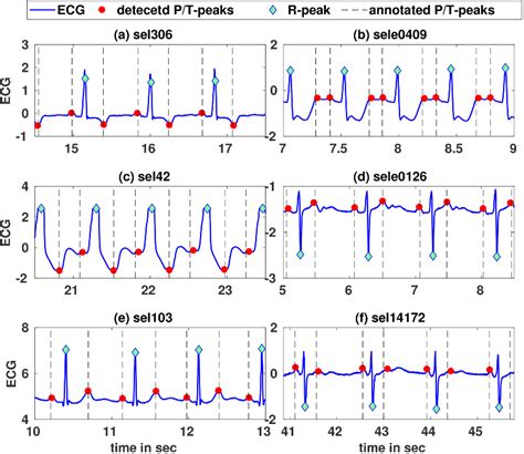 (Open Access) P- and T-wave delineation in ECG signals using parametric ...