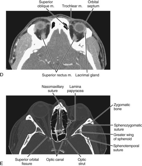 Orbit | Radiology Key