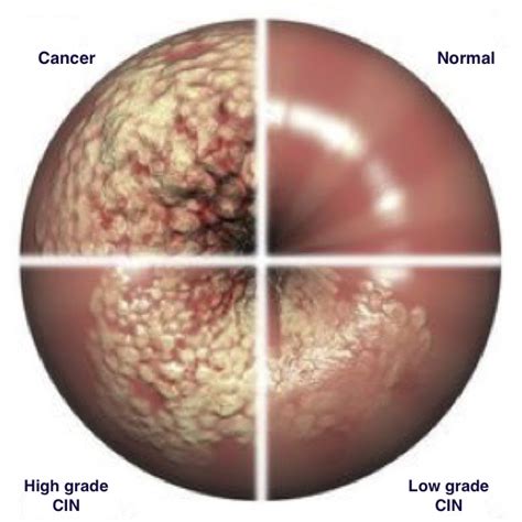 Cervical Intraepithelial Neoplasia