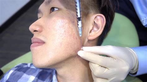 Acne Scar Keloid Steroid Injection - Dr Ho Rui Ming, Singapore - YouTube