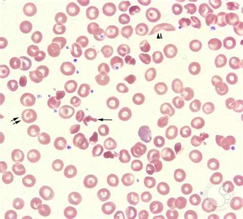 Red Blood Cell Inclusions and Abnormalities - HEMATOLOGY