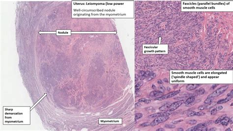 Uterus – Leiomyoma – NUS Pathweb :: NUS Pathweb