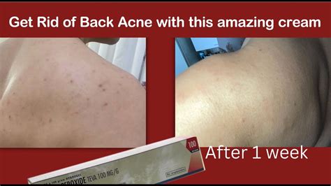 HOW I CURED MY BACK ACNE (Before/After Photos)BACK ACNE TREATMENT/درمان ...