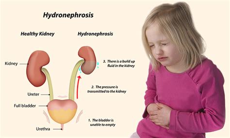 Hydronephrosis In Children - Causes, Symptoms And Treatment