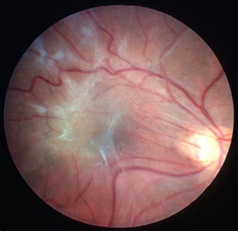 Macular Pucker - Retina Image Bank