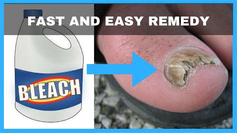 How To Cure Toenail Fungus At Home Fast - Nail Ftempo