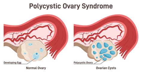 Understanding Hormonal Imbalances in PCOS