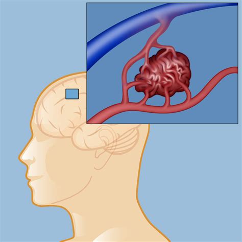 Avm Brain Hemorrhage