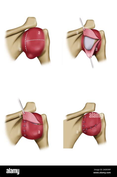 Shoulder joint capsule surgery, illustration. This view shows how the outer layers of the ...