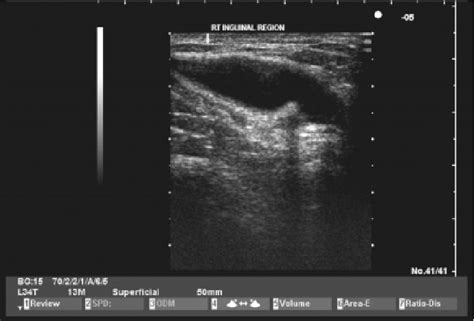 Figure 1 from The Hydrocele Of The Canal Of Nuck: An Ultrasound Diagnosis | Semantic Scholar