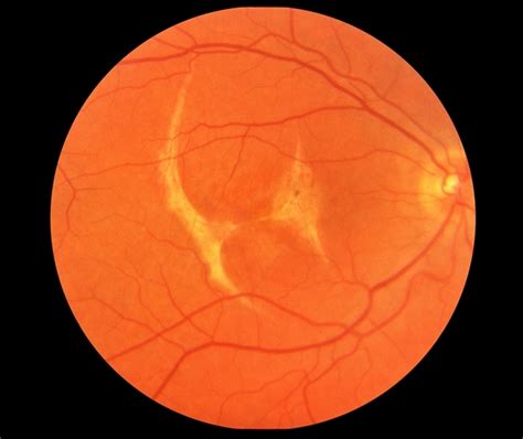 Choroidal Rupture - Retina Image Bank