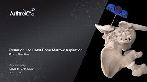 Posterior Iliac Crest Bone Marrow Aspiration - Prone Position - YouTube