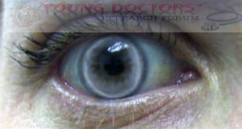 Photos For Arcus Senilis ~ YOUNG DOCTORS' RESEARCH FORUM