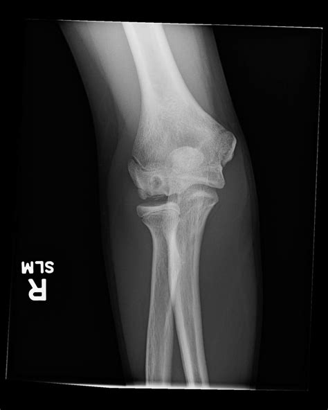 OrthoDx: Pain at the Radiocapitellar Joint - Clinical Advisor