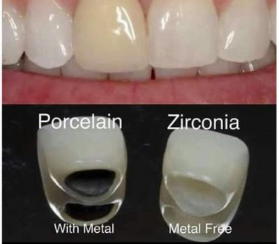 zirconia crown vs metal ceramic crown which material is better - Sri ...