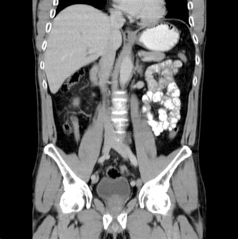 What Is A Ct Scan With Contrast Of The Abdomen