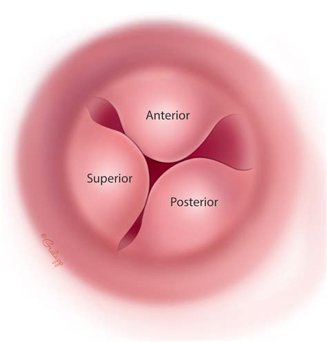 Exostoses of the Ear Canal – Oto Surgery Atlas