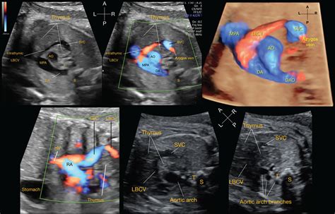 Deviated right superior vena cava: fetal echocardiographic sign of ...