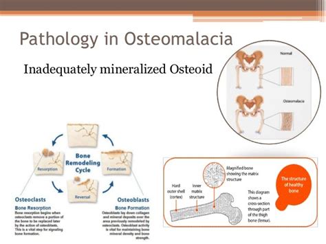 Guide to Osteomalacia – All About Bone Health and Joint Care