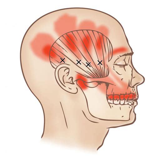 Temporalis - Trigger Point - Learn Muscles