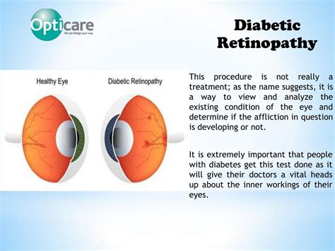 PPT - Importance of Diabetic Retinal Screening PowerPoint Presentation ...