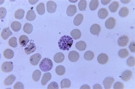 Free picture: plasmodium falciparum, malaria, parasite, blood, sample, patient