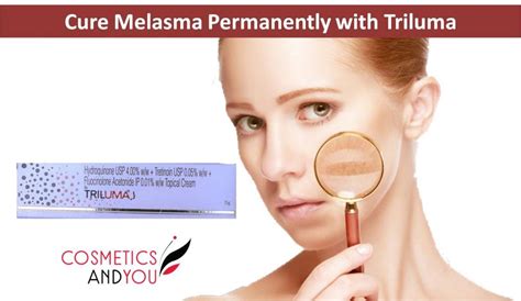 How to Cure Melasma Permanently – Cosmetics and you : Acne Treatment ...