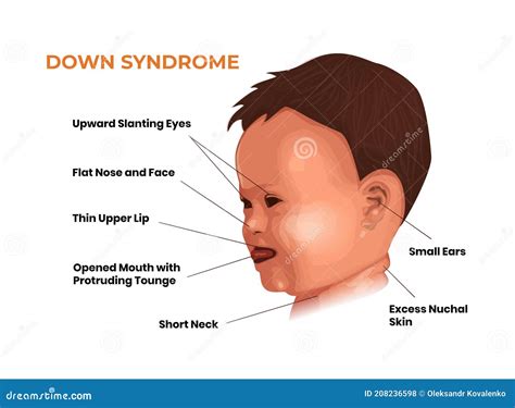 Face Features Of The Baby With Down Syndrome. Trisomy 21 Symptoms Vector Illustration ...