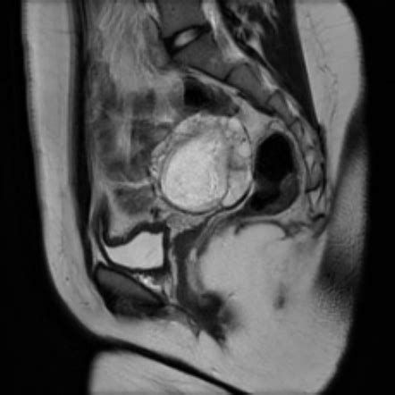 Ovarian dermoid cyst | Image | Radiopaedia.org