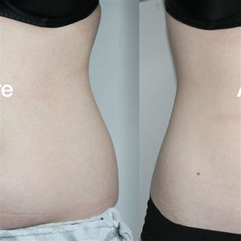 Coolsculpting Before and After: Results, Side Effects, and What to Expect - Must Read This ...