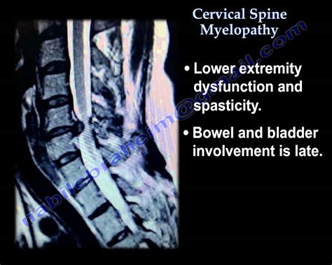 Cervical Myelopathy: We Wanted to Know - Top NYC Spine Surgeon