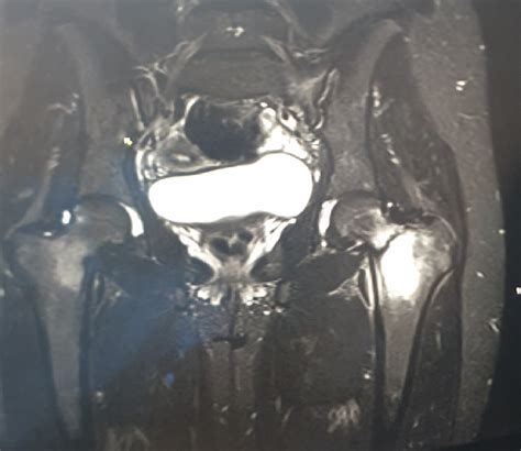 MRI of the pelvis: Bilateral Femoral neck stress fractures (Left ...