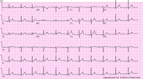 Ectopic Atrial Rhythm Archives - ECG Made Simple