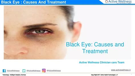 PPT - Black Eye : Causes And Treatment PowerPoint Presentation, free download - ID:12520227