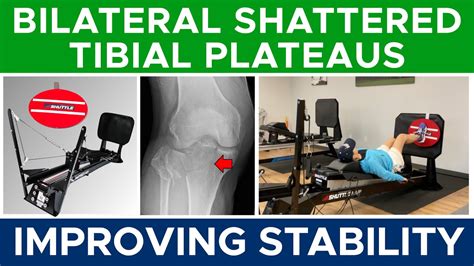 Bilateral Tibial Plateau Fractures: Improving Single-Leg Stability | Exercise Progression - YouTube