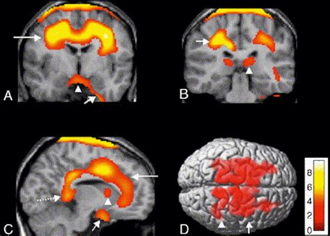 Narcolepsy Brain Damage