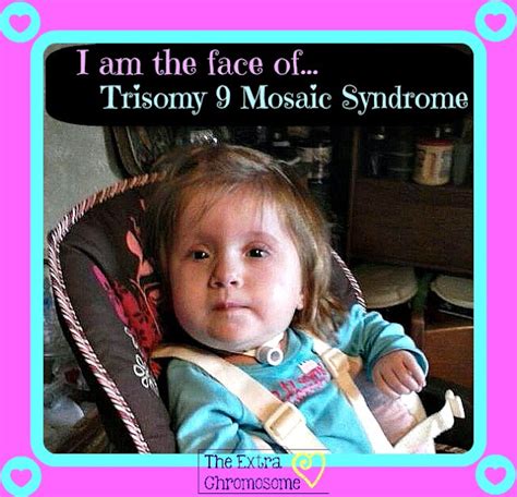 The Extra Chromosome: Trisomy 9 Mosaic