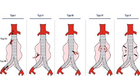 Classification of White -five types of endoleaks. The image is obtained ...