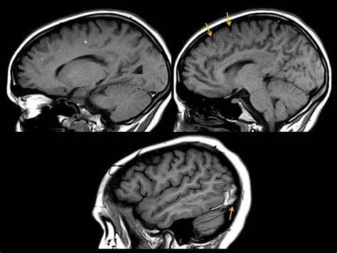 Diffuse axonal injury: CT and MRI typical findings | Eurorad