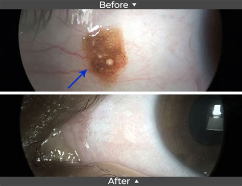 Conjunctival Nevus Removal Before and After Pictures