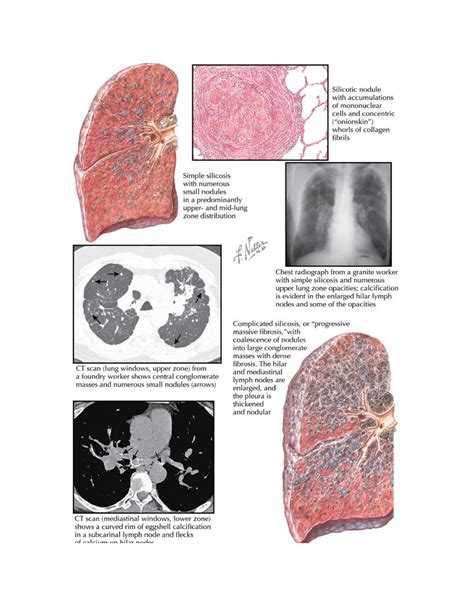 Engineered Stone Quartz Countertop Silicosis | Cancer Lawsuit