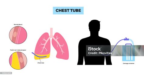 Chest Tube Catheter Stock Illustration - Download Image Now - Chest - Torso, Tube, Drainage - iStock