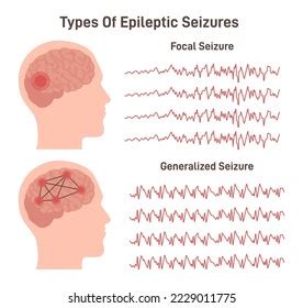 Types Epilepsy Generalized Focal Seizures Human Stock Vector (Royalty Free) 2229011775 ...