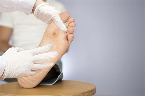 Study Suggests Possible Link Between Diabetic Foot Ulcers, Diminished Cognitive Function ...